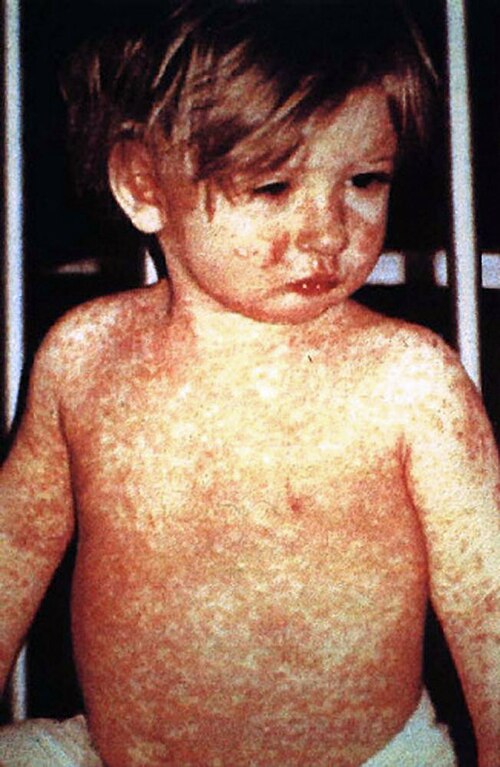 Image of a child with measles.